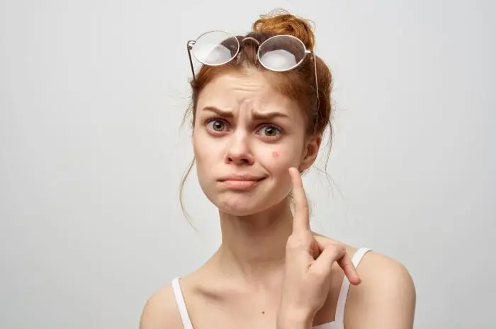 Rekomendasi Skincare Melawan Bekas Jerawat